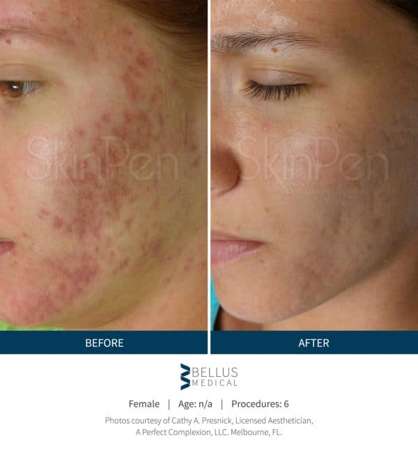 Microneedling Denver Acne Scars Before & After