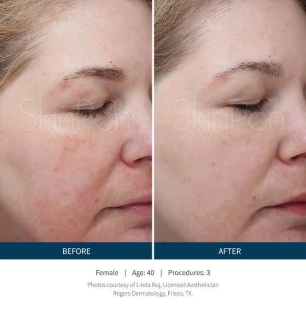 SkinPen Microneedling Denver Acne Female