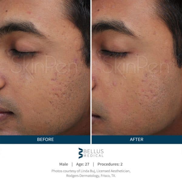SkinPen Microneedling Male Before & After
