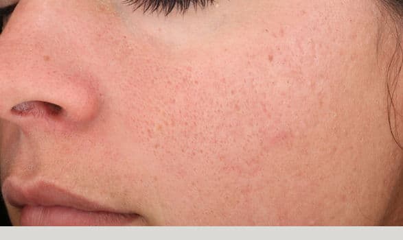 SpaMedica Rejuvinze Chemical Peel Denver After 1