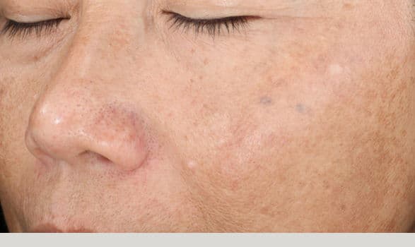 SpaMedica Rejuvinze Chemical Peel Denver After 2