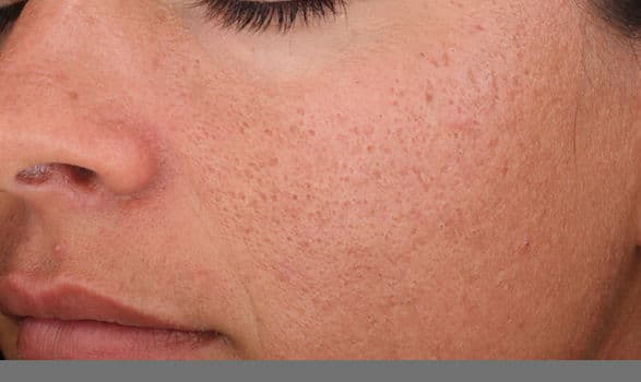 SpaMedica Rejuvinze Chemical Peel Denver Before 1
